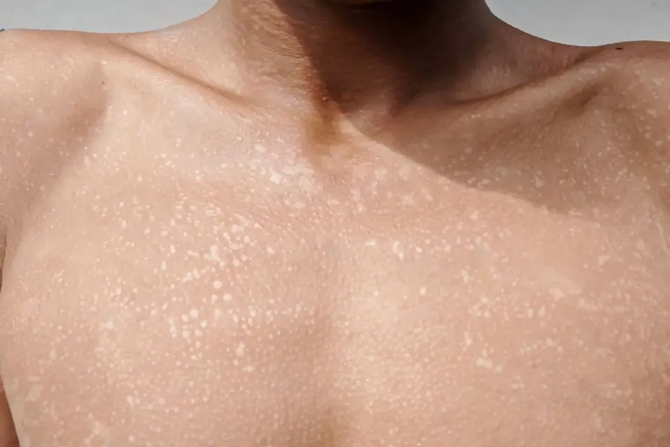 Close-up of small white spots on skin caused by sun damage, often associated with vitamin deficiency.