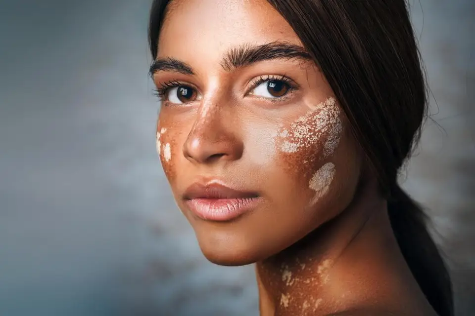 Woman with small white spots on her face, illustrating vitiligo related to vitamin deficiency.